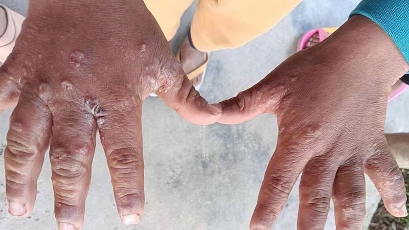 သတ္တုတူးဖော်ရာတွင်သုံးသည့် ဓာတုဆေးရည်ကြောင့် အရေပြားရောဂါ ခံစားနေရသည့် ကချင်ပြည်နယ်၊ အင်ခေါင်းပါရွာမှ ဒေသခံတစ်ဦးအား တွေ့ရစဉ်။ (Photo: The 74Media)